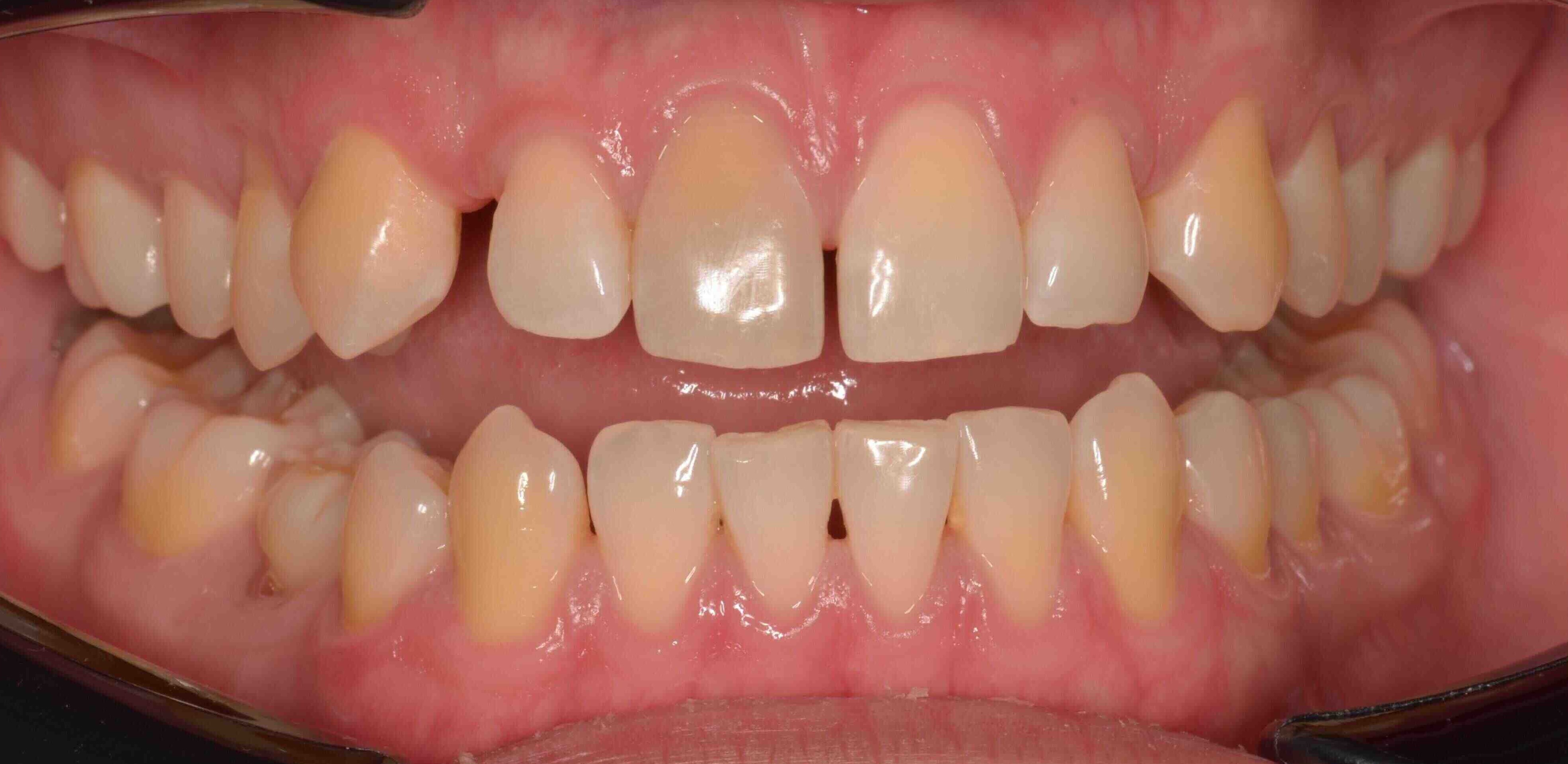 Invisalign and whitening transformation